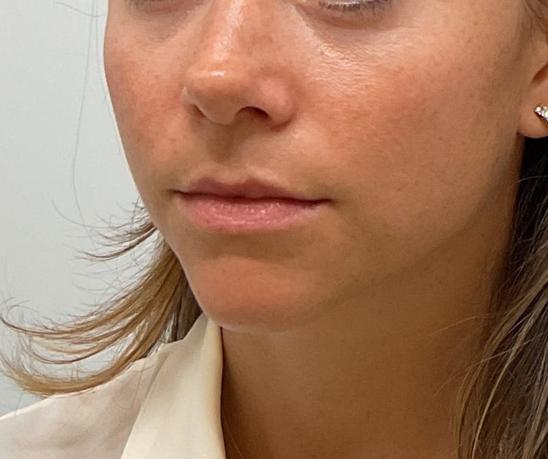 Lips Before & After Gallery - Patient 296285 - Image 1