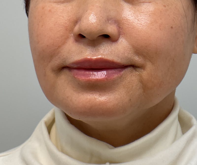 Lips Before & After Gallery - Patient 401641 - Image 2