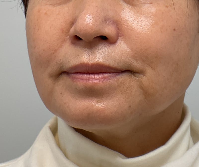 Lips Before & After Gallery - Patient 401641 - Image 1