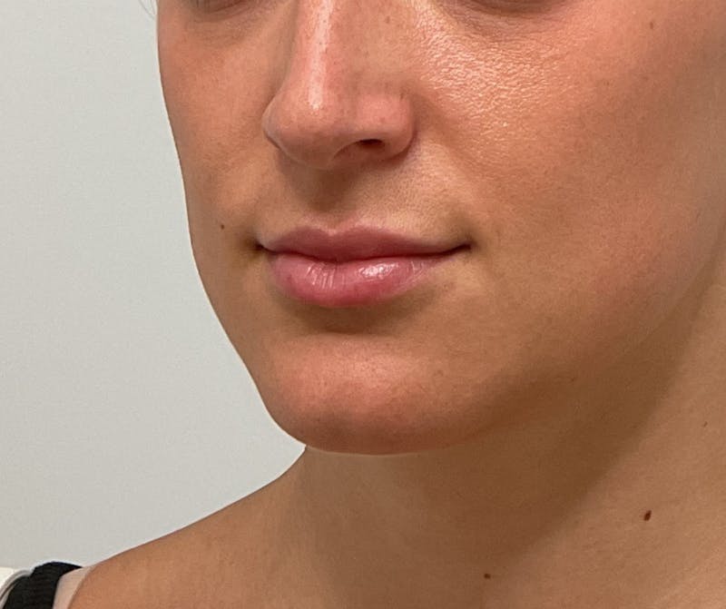 Lips Before & After Gallery - Patient 318116 - Image 2