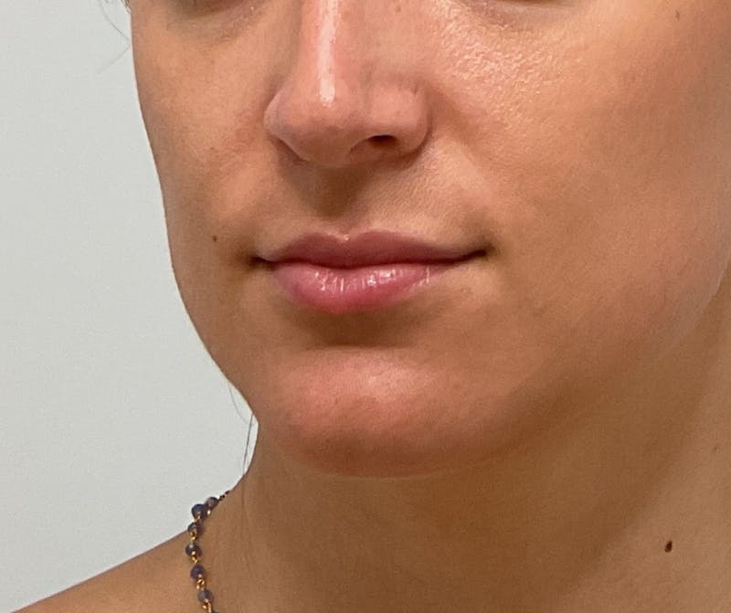 Lips Before & After Gallery - Patient 318116 - Image 1