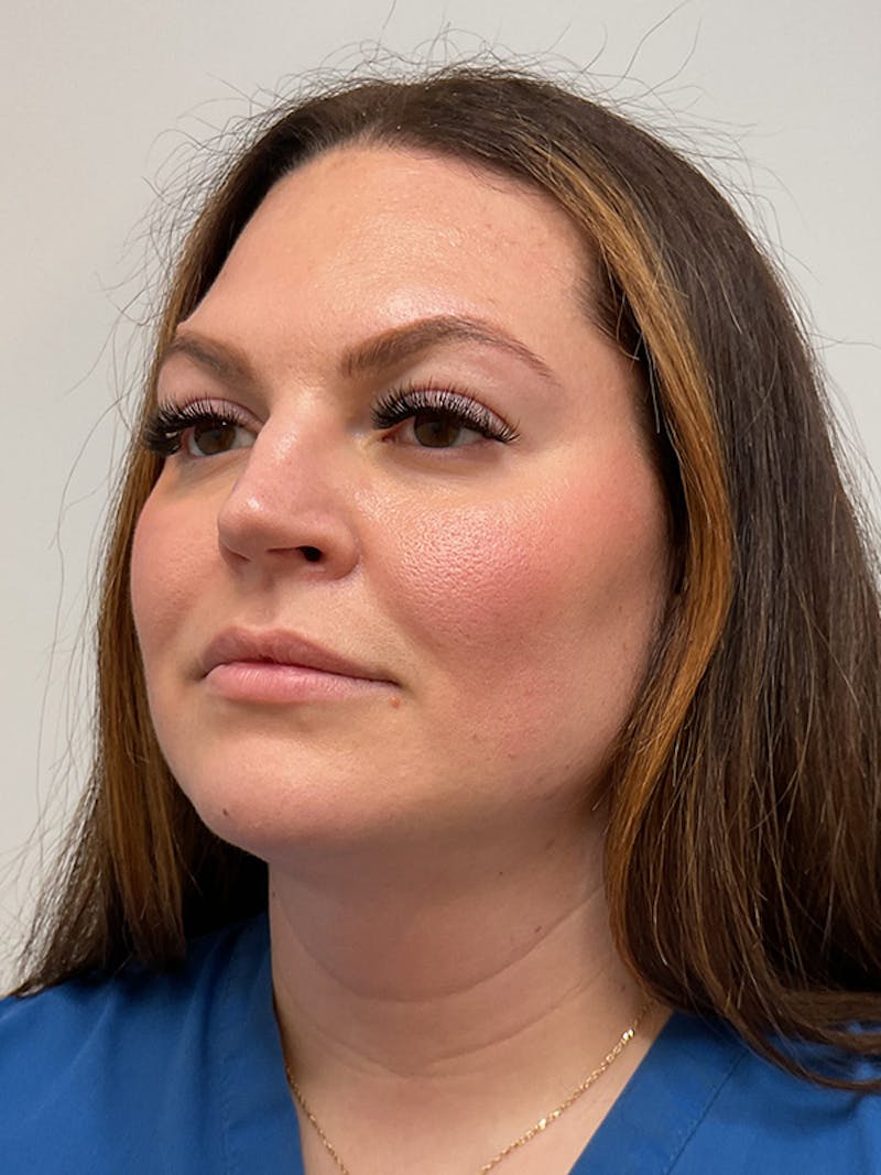 Facial Balancing Before & After Gallery - Patient 261797 - Image 1