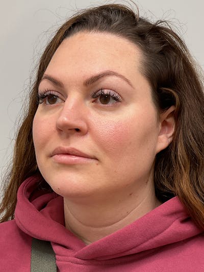 Facial Balancing Before & After Gallery - Patient 261797 - Image 2