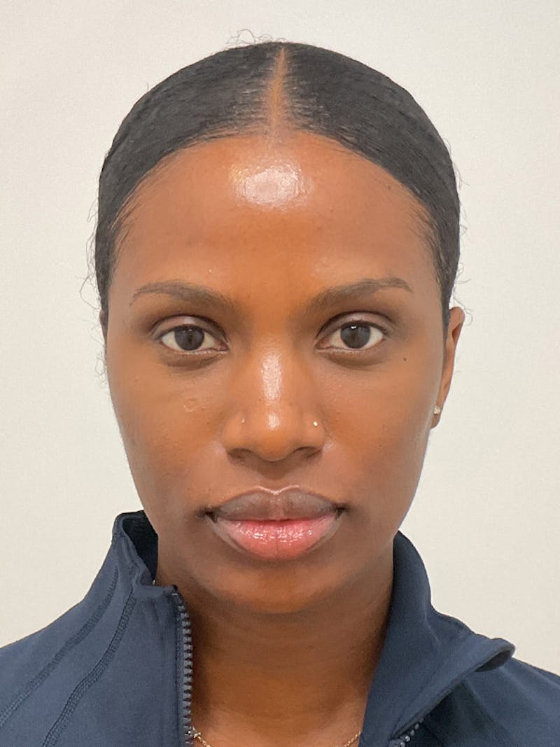 Facial Balancing Before & After Gallery - Patient 756667 - Image 1