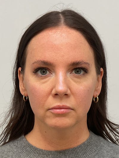 Facial Balancing Before & After Gallery - Patient 307362 - Image 1