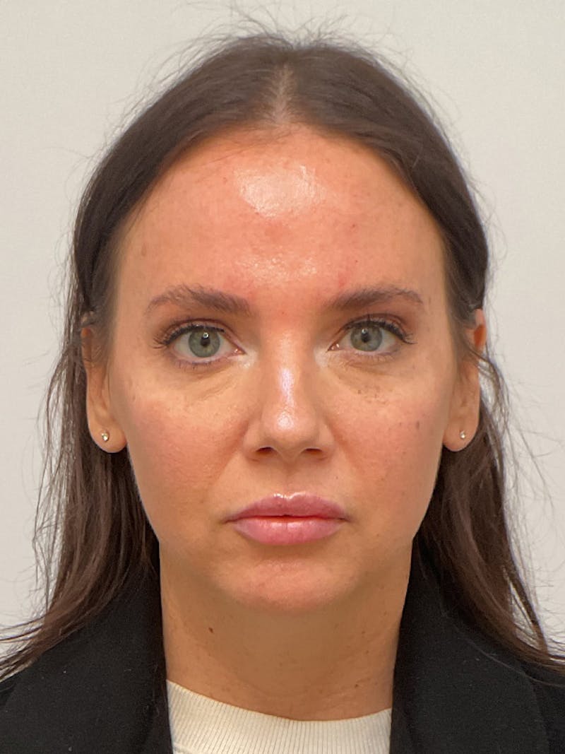 Facial Balancing Before & After Gallery - Patient 307362 - Image 2