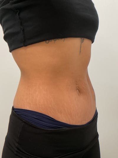 Body Before & After Gallery - Patient 120474 - Image 2