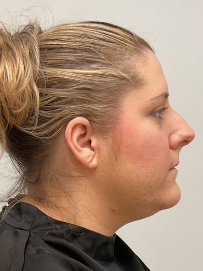 Kybella Before & After Gallery - Patient 350544 - Image 1
