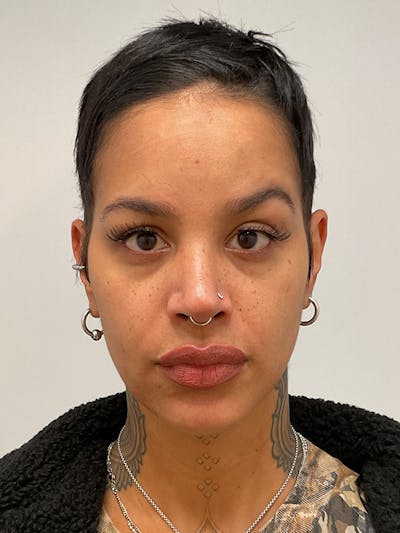 Hydrafacial Before & After Gallery - Patient 180241 - Image 1