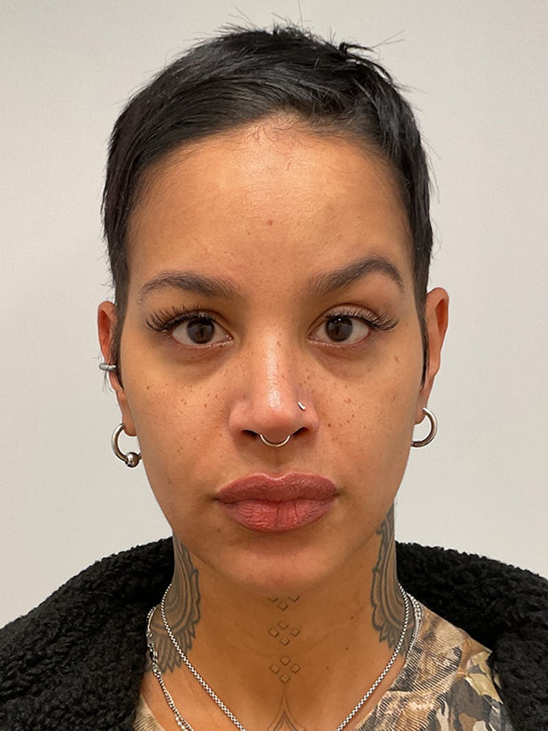 Hydrafacial Before & After Gallery - Patient 180241 - Image 1