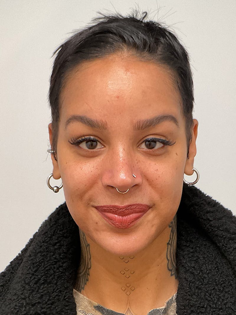 Hydrafacial Before & After Gallery - Patient 180241 - Image 2
