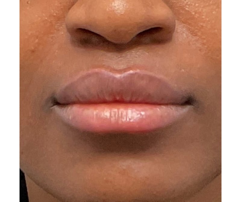 Lips Before & After Gallery - Patient 202673 - Image 2