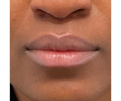 Lips Before & After Gallery - Patient 202673 - Image 1