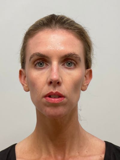 Facial Balancing Before & After Gallery - Patient 357773 - Image 1