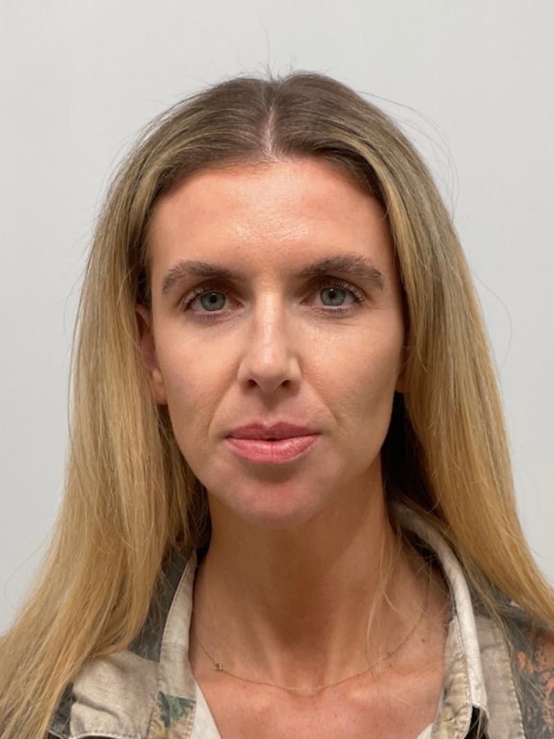 Facial Balancing Before & After Gallery - Patient 357773 - Image 2