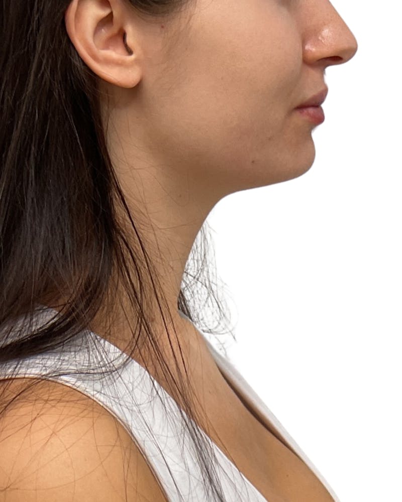 Facial Balancing Before & After Gallery - Patient 234338 - Image 1