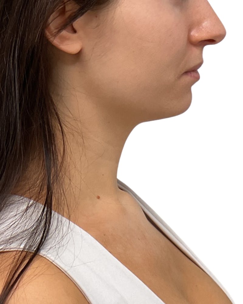 Facial Balancing Before & After Gallery - Patient 234338 - Image 2