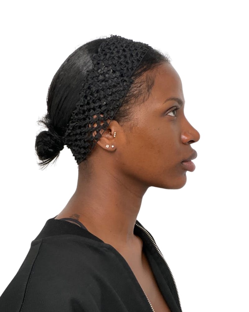 Facial Balancing Before & After Gallery - Patient 756667 - Image 4