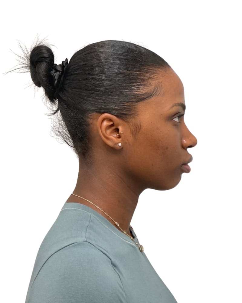 Facial Balancing Before & After Gallery - Patient 756667 - Image 3