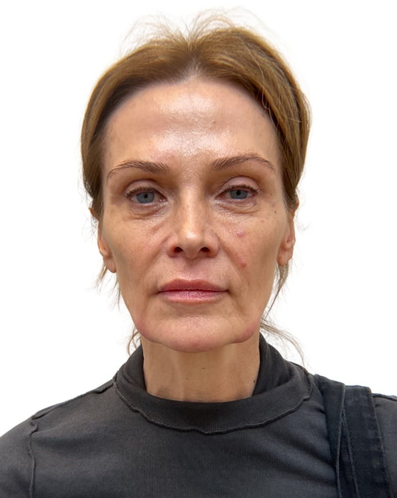 Facial Balancing Before & After Gallery - Patient 283250 - Image 1