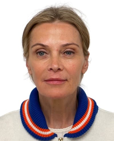 Facial Balancing Before & After Gallery - Patient 283250 - Image 2
