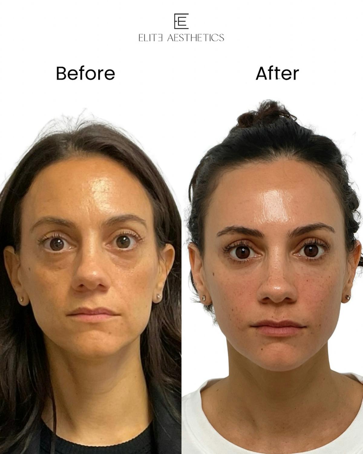Facial Balancing - archived Before & After Gallery - Patient 144603 - Image 1