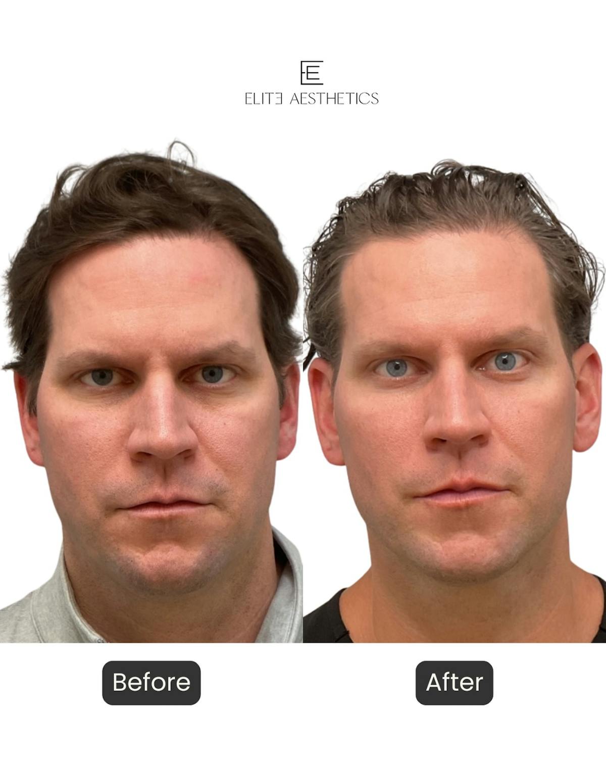 Facial Balancing - archived Before & After Gallery - Patient 271524 - Image 1