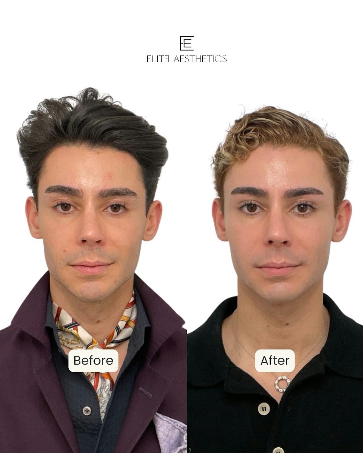 Facial Balancing - archived Before & After Gallery - Patient 158551 - Image 1