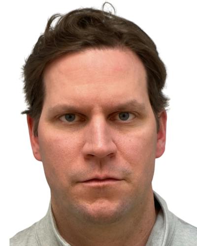 Facial Balancing Before & After Gallery - Patient 164410 - Image 1