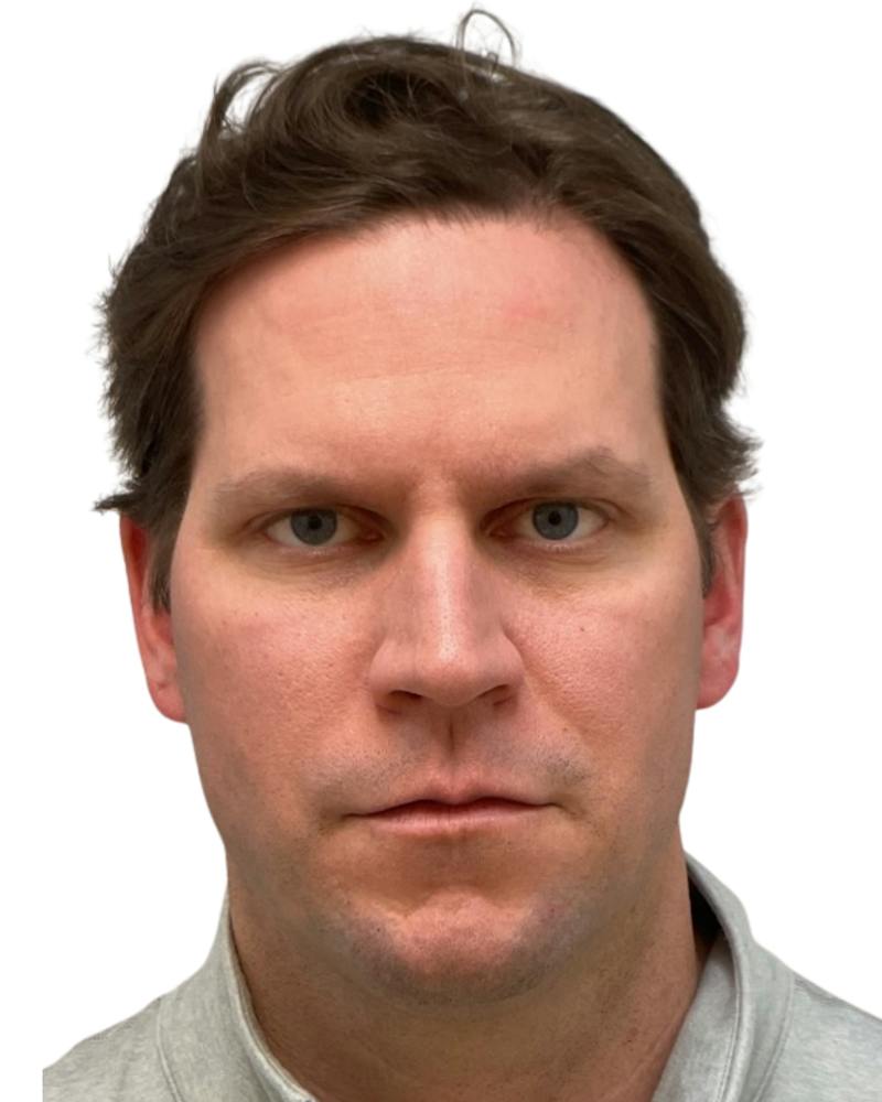Facial Balancing Before & After Gallery - Patient 164410 - Image 1
