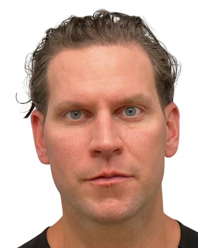 Facial Balancing Before & After Gallery - Patient 164410 - Image 2