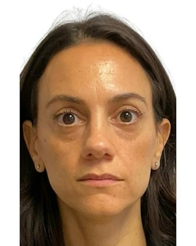 Facial Balancing Before & After Gallery - Patient 813268 - Image 1