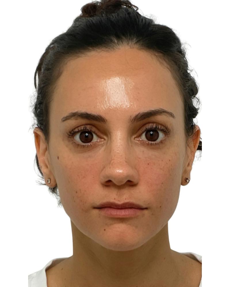 Facial Balancing Before & After Gallery - Patient 813268 - Image 2