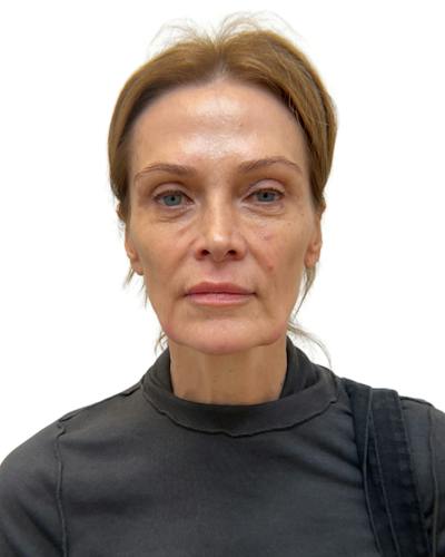 Facial Balancing Before & After Gallery - Patient 283250 - Image 1