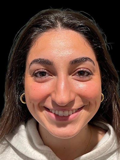 Rhinoplasty Before & After Gallery - Patient 424773 - Image 1