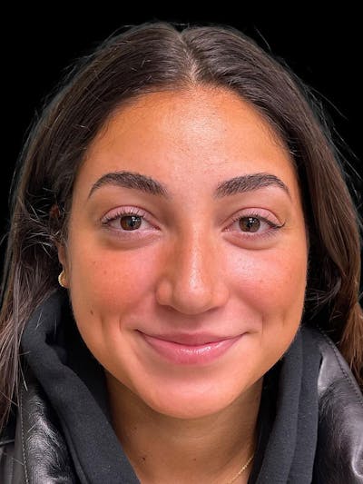 Rhinoplasty Before & After Gallery - Patient 424773 - Image 2