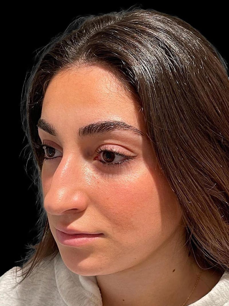 Rhinoplasty Before & After Gallery - Patient 424773 - Image 3