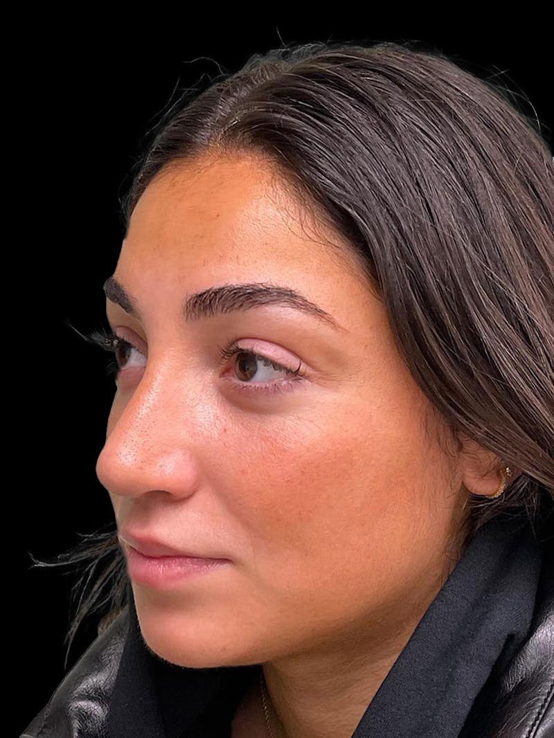 Rhinoplasty Before & After Gallery - Patient 424773 - Image 4