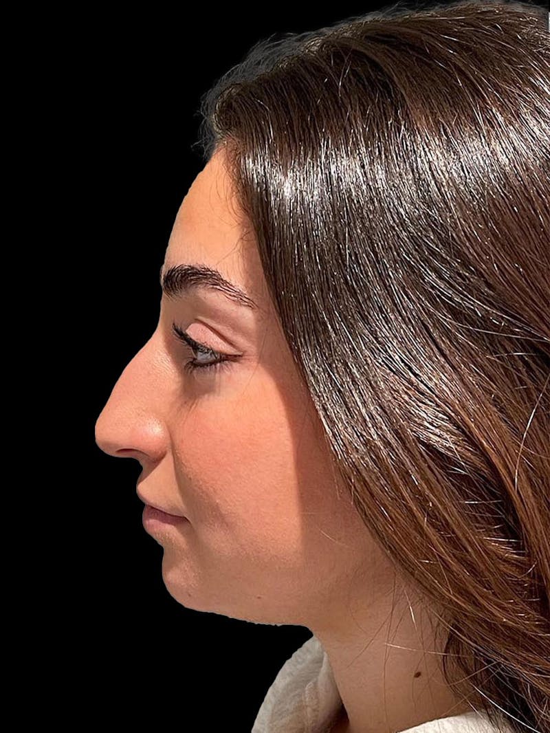 Rhinoplasty Before & After Gallery - Patient 424773 - Image 5