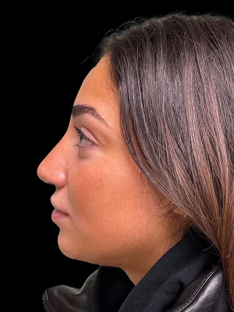 Rhinoplasty Before & After Gallery - Patient 424773 - Image 6
