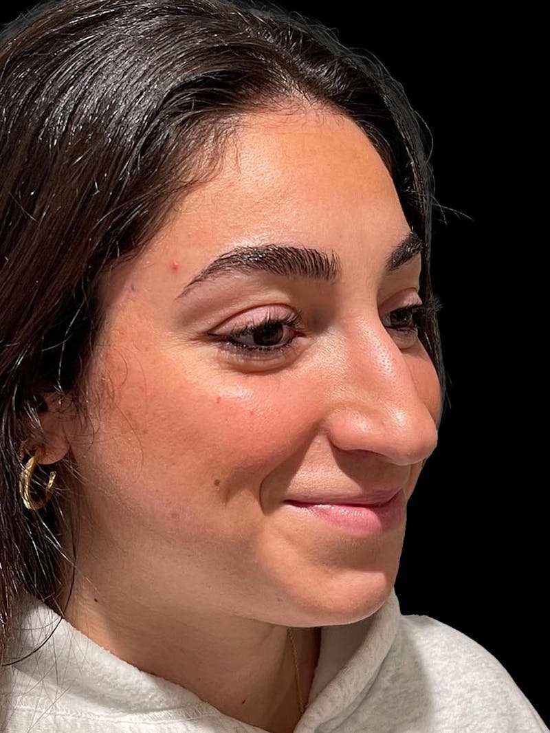 Rhinoplasty Before & After Gallery - Patient 424773 - Image 7