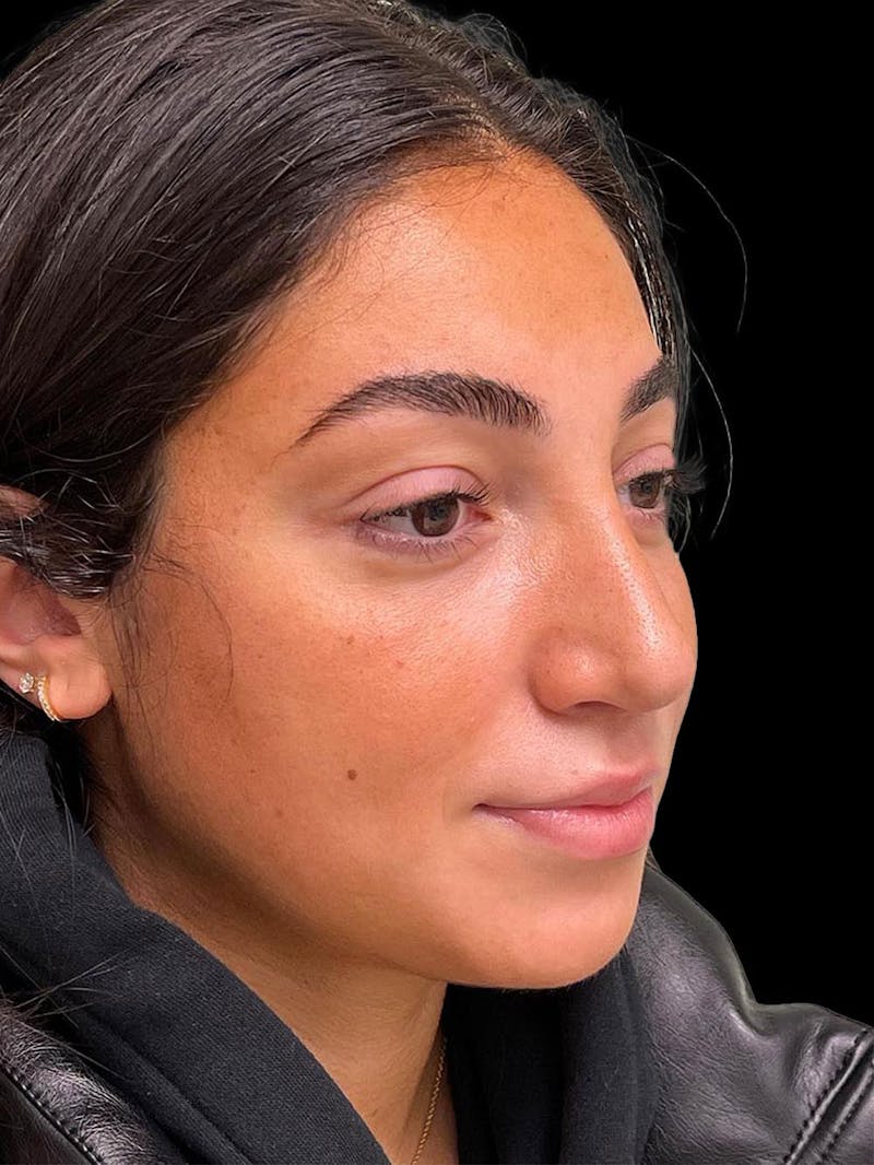 Rhinoplasty Before & After Gallery - Patient 424773 - Image 8