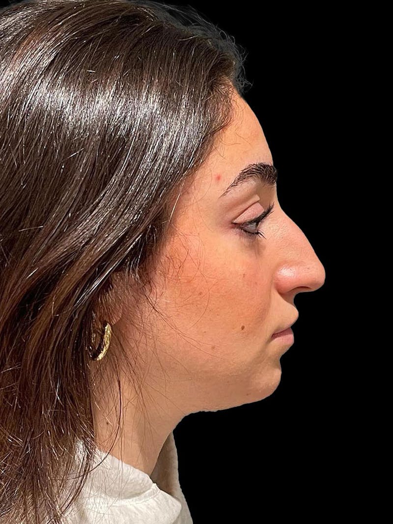 Rhinoplasty Before & After Gallery - Patient 424773 - Image 9