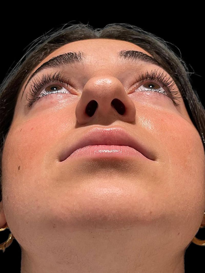 Rhinoplasty Before & After Gallery - Patient 424773 - Image 11