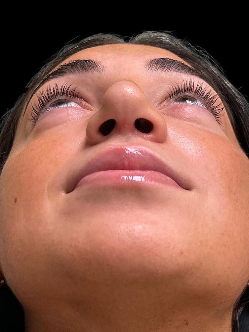 Rhinoplasty Before & After Gallery - Patient 424773 - Image 12