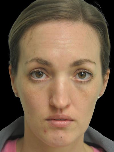 Rhinoplasty Before & After Gallery - Patient 778116 - Image 1