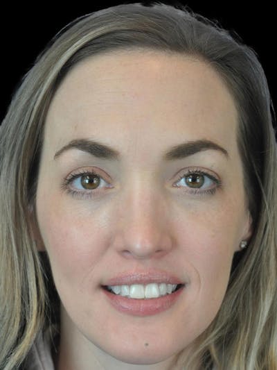 Rhinoplasty Before & After Gallery - Patient 778116 - Image 2