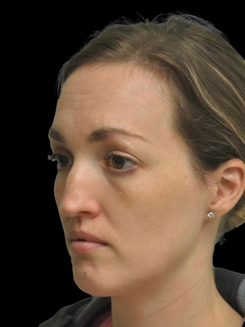 Rhinoplasty Before & After Gallery - Patient 778116 - Image 3