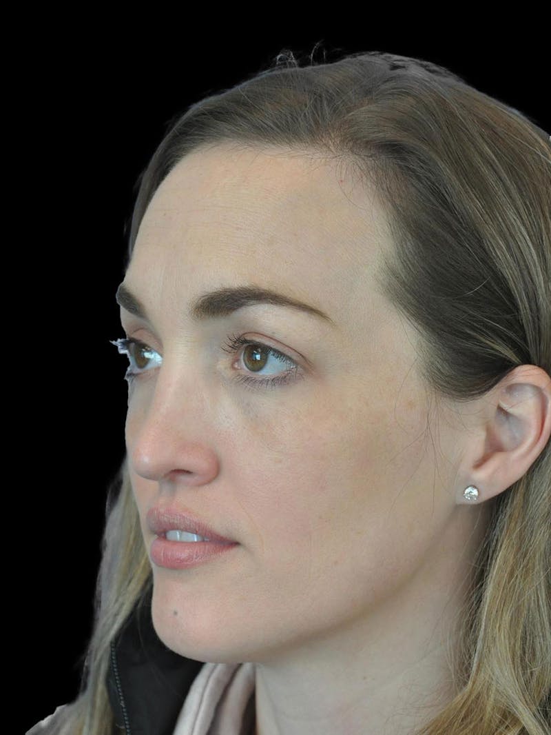 Rhinoplasty Before & After Gallery - Patient 778116 - Image 4