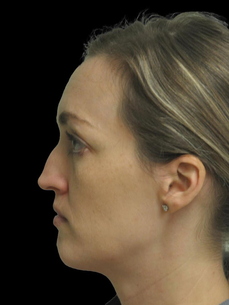 Rhinoplasty Before & After Gallery - Patient 778116 - Image 5